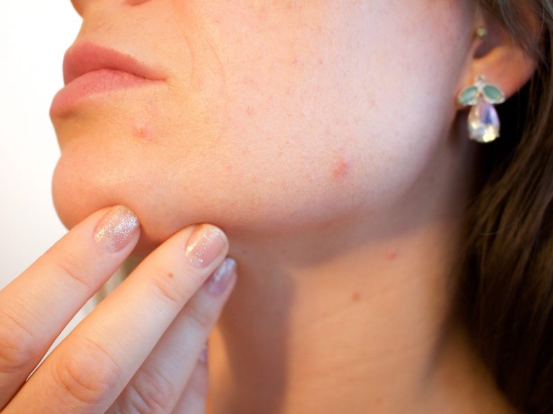 What Causes Of Blackheads on Chin and How to Treat Them