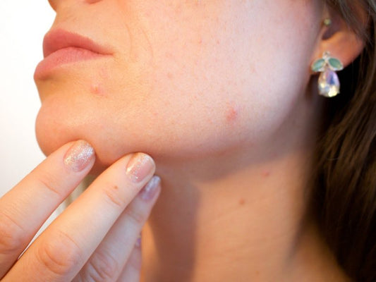 What Causes Of Blackheads on Chin and How to Treat Them