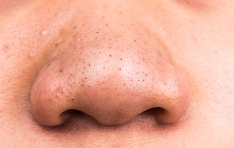 Home Remedies for Whiteheads Removal